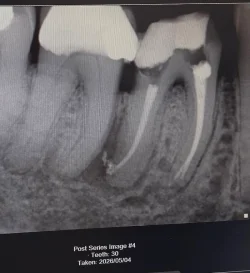 After root canal (1).webp After root canal (1).webp